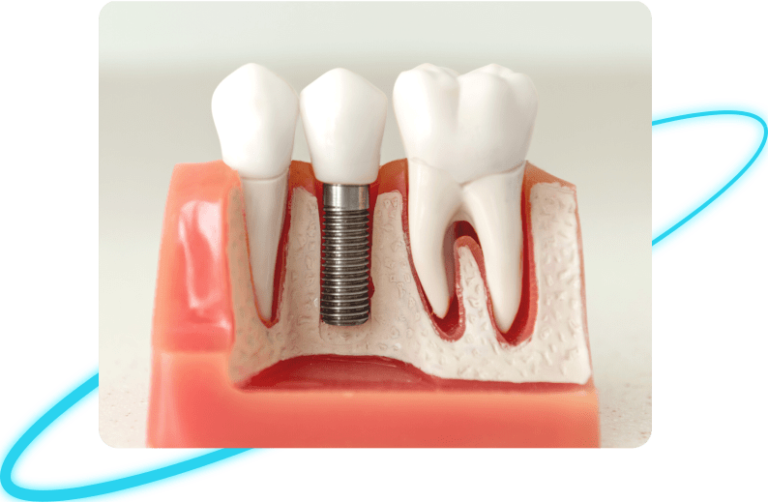 Dental Implants in Whittier