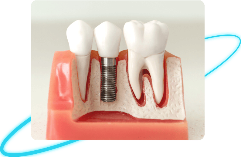 Dental implants service in Whittier OR Dental implants treatment in Whittier