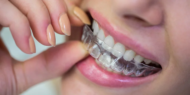 Invisalign: The Modern Way to Straighten Your Teeth - Friendly Hills ...