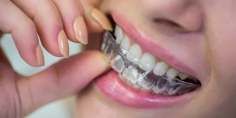 Invisalign – Revolutionary Teeth Straightening