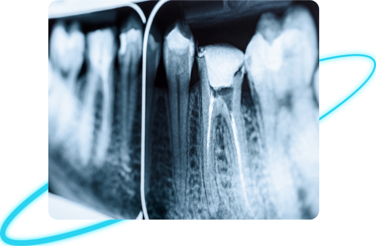 Root Canal Treatment in Whittier