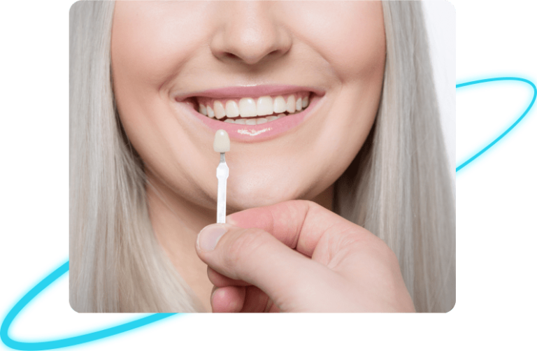 Veneers in Whittier